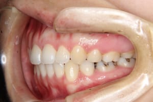 前歯の叢生も改善し口元も下がっています。